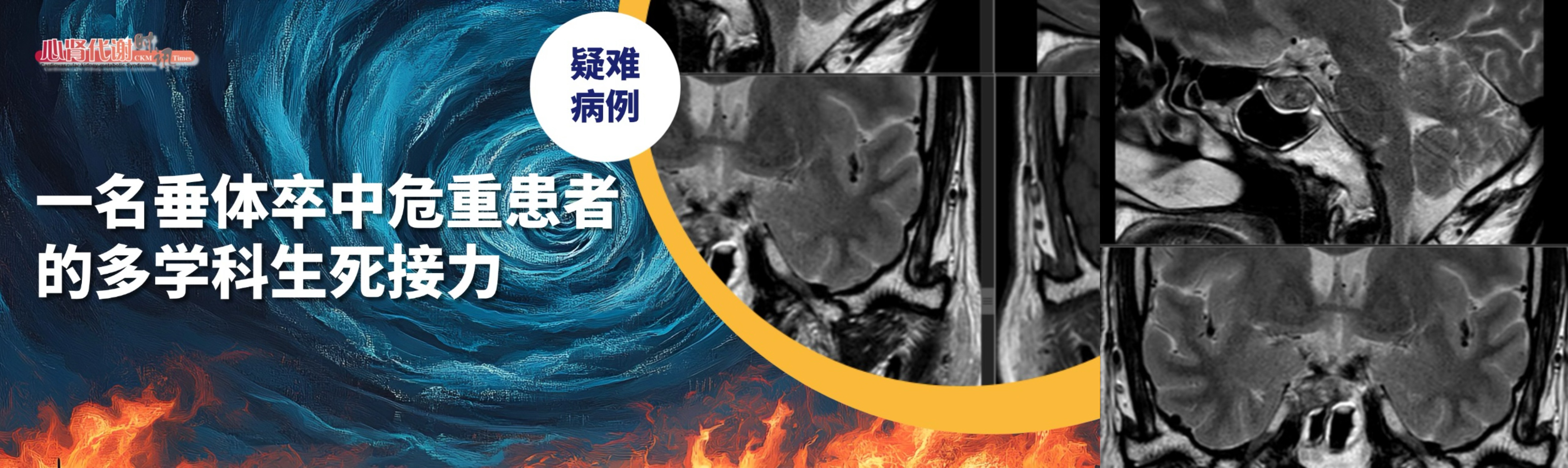 疑难病例讨论｜“颅内风暴”：一名垂体卒中危重患者的多学科生死接力